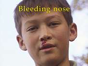 Bleeding nose